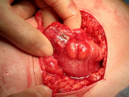 Photograph showing the sigmoid colonic perforation. Figure taken from Joglekar et al., "Sigmoid perforation caused by an ingested chicken bone presenting as right iliac fossa pain mimicking appendicitis: a case report"